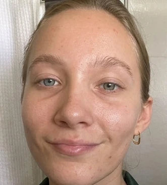 Peau de Sofie après 2 semaines